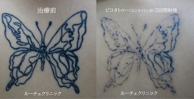 タトゥー除去ピコレーザー、3回、背中、黒