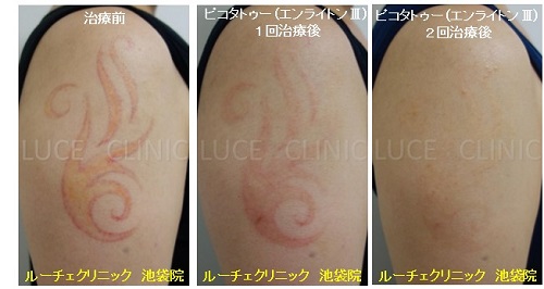タトゥー除去ピコレーザー、2回、腕、赤、黄色、経過