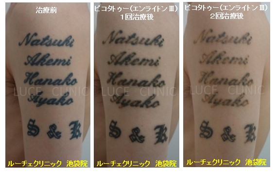 タトゥー除去ピコレーザー、２回、腕、黒