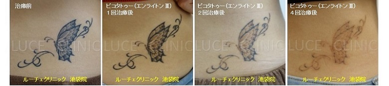 タトゥー除去ピコレーザー、４回、腰、黒