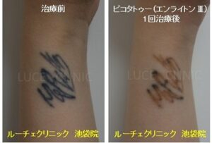 タトゥー除去ピコレーザー、1回、手首、黒の症例写真ビフォーアフター