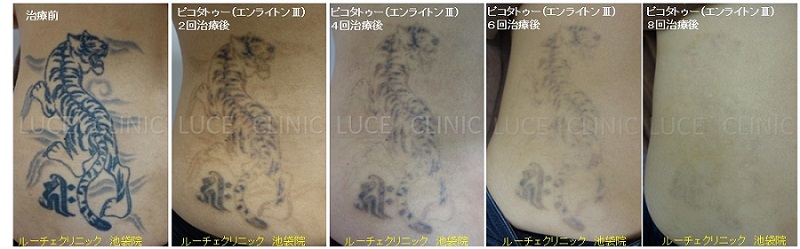 タトゥー除去ピコレーザー、8回、腰、黒、経過、とれた