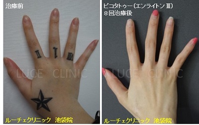 タトゥー除去ピコレーザー、8回、手、指、黒、とれた