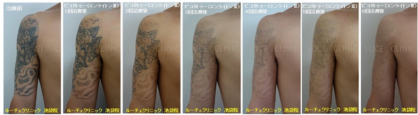タトゥー除去ピコレーザー、6回、腕、黒、経過、消えた取れた