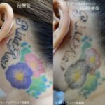 タトゥー除去ピコレーザー、３回、首、ピンク、紫、黒、緑、黄色