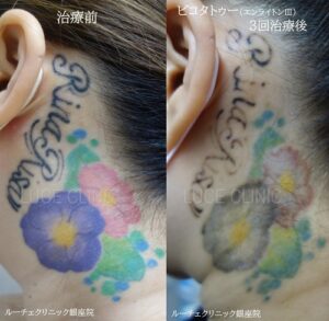 タトゥー除去ピコレーザー、3回、耳裏、ピンク、紫、黒、緑、黄色の症例写真ビフォーアフター
