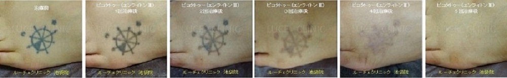 タトゥー除去ピコレーザー、５回、足、黒、経過、取れた消えた