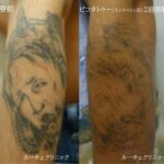 タトゥー除去ピコレーザー、2回、腕、黒、赤
