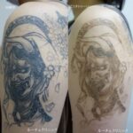 タトゥー除去、2回、腕、黒