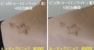 タトゥー除去ピコレーザー、5回、鎖骨、黒、経過