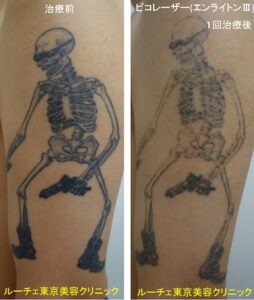 ガイコツ柄のタトゥーの症例写真ビフォーアフター