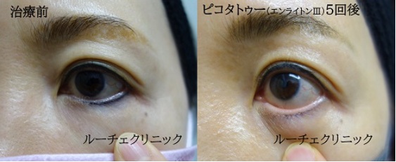 アイライン除去タトゥー除去ピコレーザーまぶた、5回、黒★