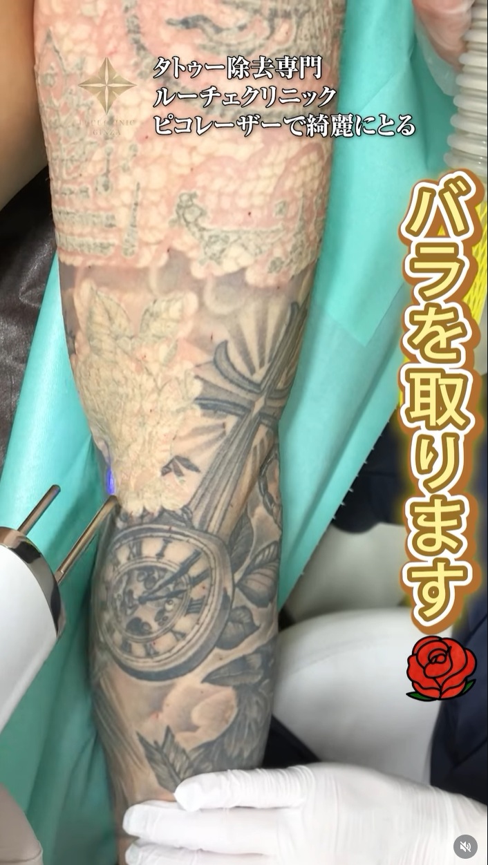 タトゥー・刺青を消すの動画