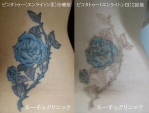 タトゥー除去ピコレーザー、腰、黒、水色