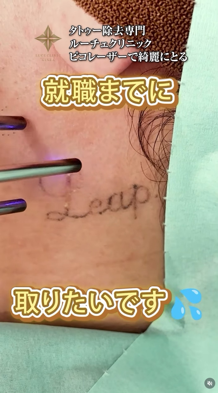 タトゥー除去症例動画