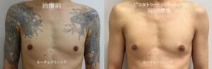 タトゥー除去ピコレーザー、８回、胸から腕、黒