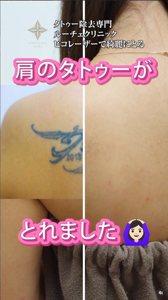 タトゥー除去症例動画