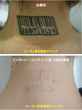 タトゥー除去ピコレーザー、4回、指、黒