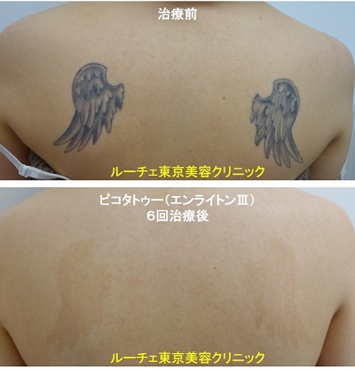 タトゥー除去ピコレーザー、背中、6回、黒、とれた