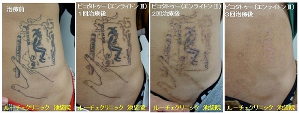 タトゥー除去ピコレーザー、2回、指、黒