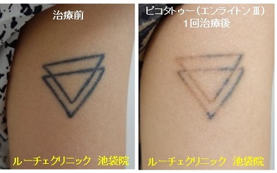 タトゥー除去ピコレーザー、4回、腕、黒