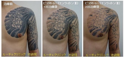 タトゥー除去ピコレーザー、7回、腰、黒