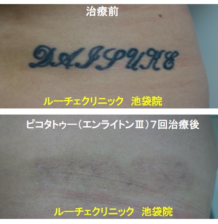 タトゥー除去ピコレーザー、腰、7回、黒、とれた