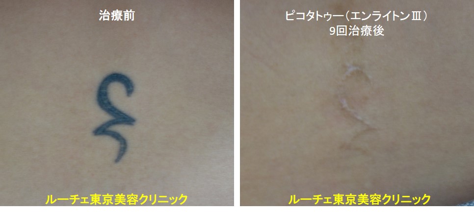 タトゥー除去ピコレーザー、9回、腰、黒、とれた
