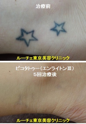 タトゥー除去ピコレーザー、6回、背中、黒