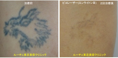 腕タトゥーにピコレーザーを照射しています＿黒2回