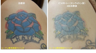 腕のカラフルタトゥーもどんどん薄くなります＿