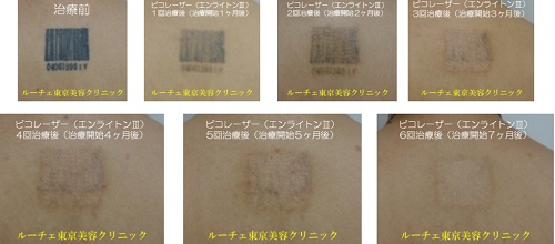 背中の黒　経過、治療終了