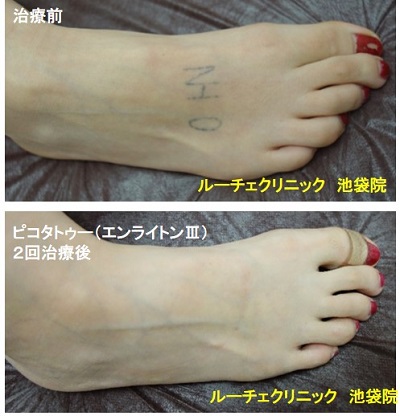 タトゥー除去ピコレーザー、1回、腕、黒、ピンク