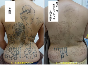 背中全体のタトゥーを薄くしています＿