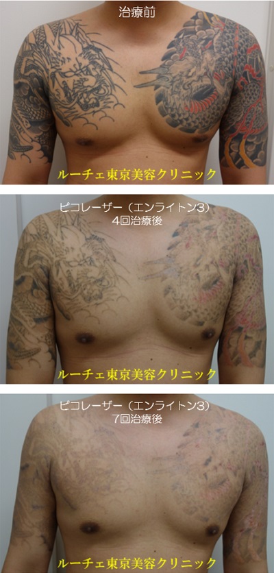 胸から両肩の広範囲カラータトゥーが薄くなっていく経過写真＿