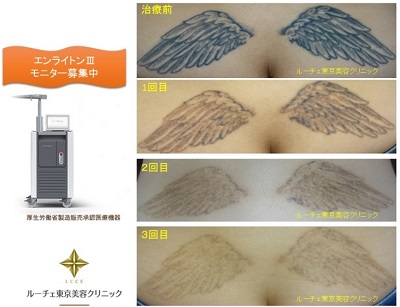 お尻の上、腰の黒タトゥーをピコレーザー消します、経過、とれた