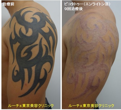 腕のべったり濃いインクのタトゥーを消していきます　9回腕黒