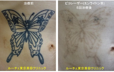 おなかのチョウチョのタトゥーにピコレーザーを照射＿黒5回
