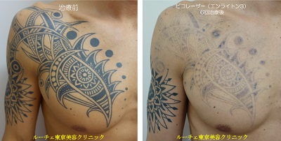 胸のタトゥーを薄くしています＿