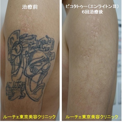 タトゥー除去ピコレーザー、6回、腕、黒、とれた