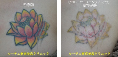 胸のカラータトゥーを薄くしています　4色5回＿