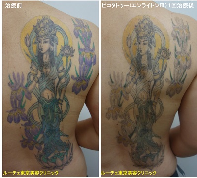 背中の大きめのカラフルタトゥーを薄くしています＿