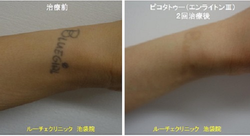 タトゥー除去ピコレーザー、腕、4回、黒