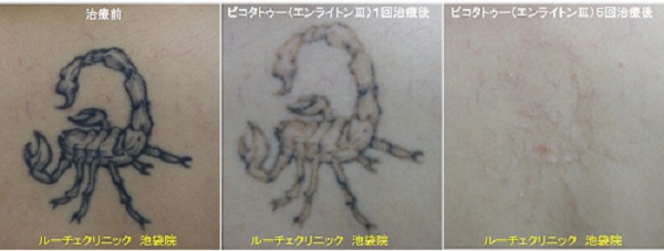 タトゥー除去ピコレーザー、足、6回、黒