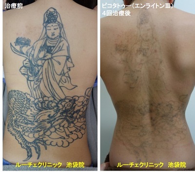 タトゥー除去ピコレーザー、腕、1回、黒