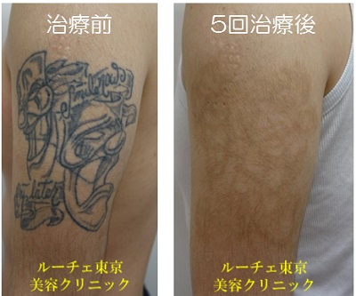 ５回でタトゥーが消えました。色素沈着があります。