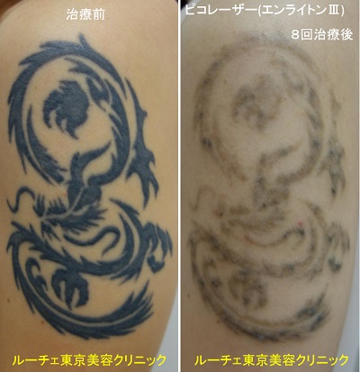腕の濃いタトゥーにピコレーザー治療をしています
