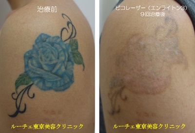 肩のカラータトゥーの経過です＿
