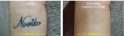 手首のタトゥー除去、とれた
