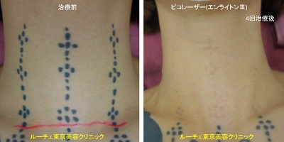 首のタトゥーがほぼ取れています。